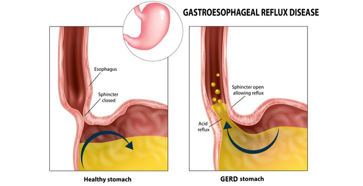 GERD: Understanding and Managing Acid Reflux